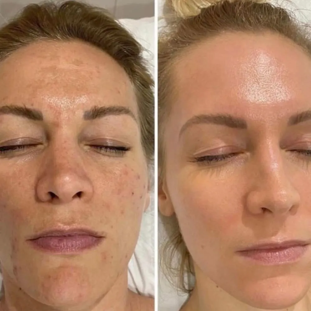 Why Choose Derma Cure for Chemical Peels